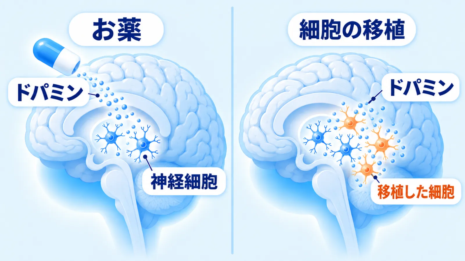 左右2場面の対比図。どちらも横から見た青い脳の奥に、ドパミンを出す神経細胞（青い星形）がある。左「お薬」では神経細胞が少なく、脳の上のカプセルから水色の粒（ドパミン）が外から降り注いでいる。右「細胞の移植」では、もとの神経細胞に移植した神経細胞（オレンジ色）が足され、その細胞自身から水色の粒（ドパミン）が出ている。ラベルは「お薬」「細胞の移植」「ドパミン」「神経細胞」と、オレンジ色の文字の「移植した細胞」