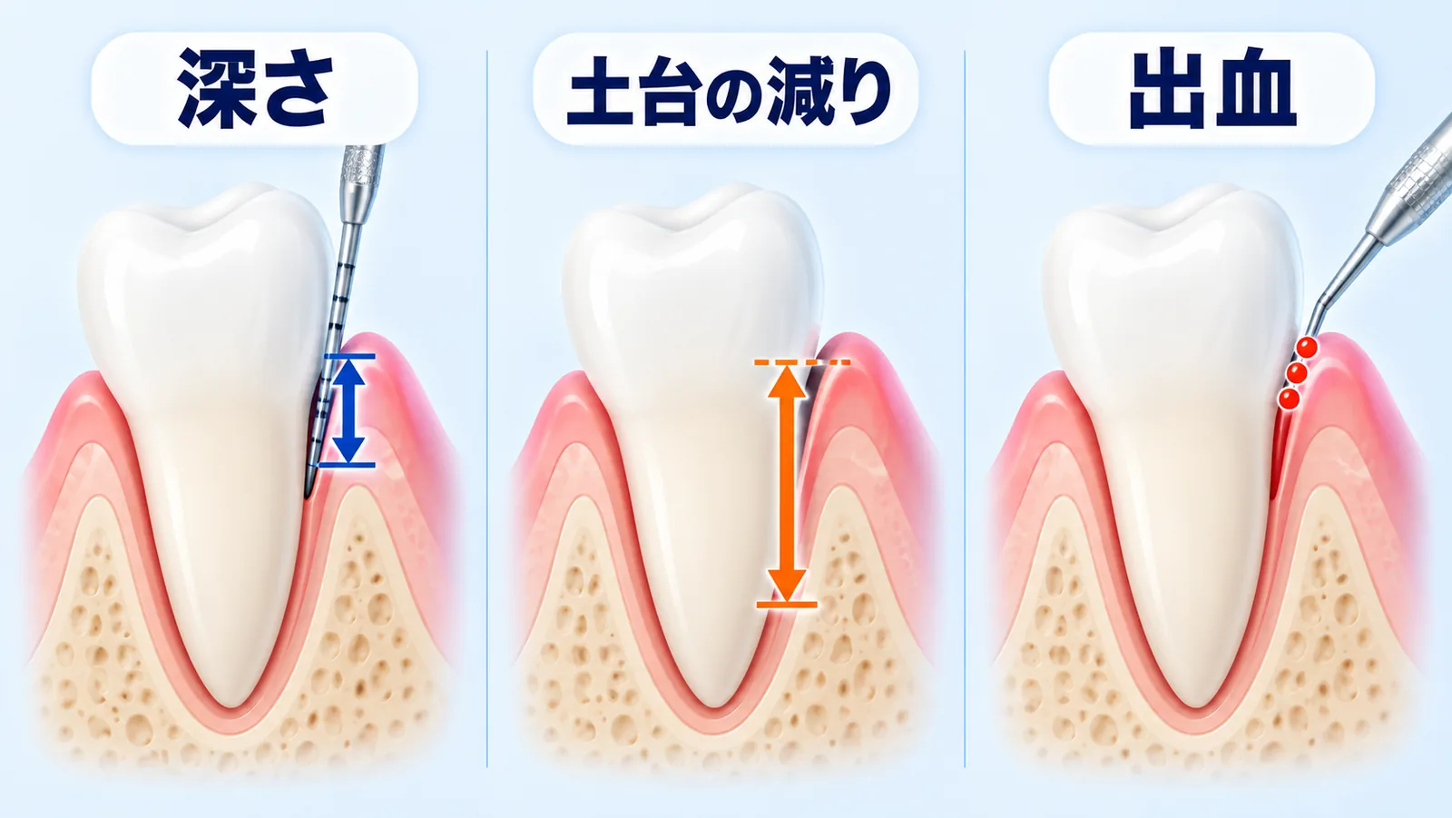 歯を1本ずつ大きく描いた断面図を3つ横に並べた対比図。左は、歯と歯ぐきのあいだの溝に目盛りの付いた細い器具を差し込み、溝の深さを青い両向きの矢印で示している。中央は、歯の付け根の高さを表すオレンジの破線から溝の底までを、1本の長いオレンジの両向き矢印で示している。右は、同じ器具を歯ぐきに当てた場所に赤い小さな丸が3つ付いている。3つとも歯の形・向き・大きさは同じで、違うのは矢印と赤い丸だけ。ラベルは左から「深さ」「土台の減り」「出血」