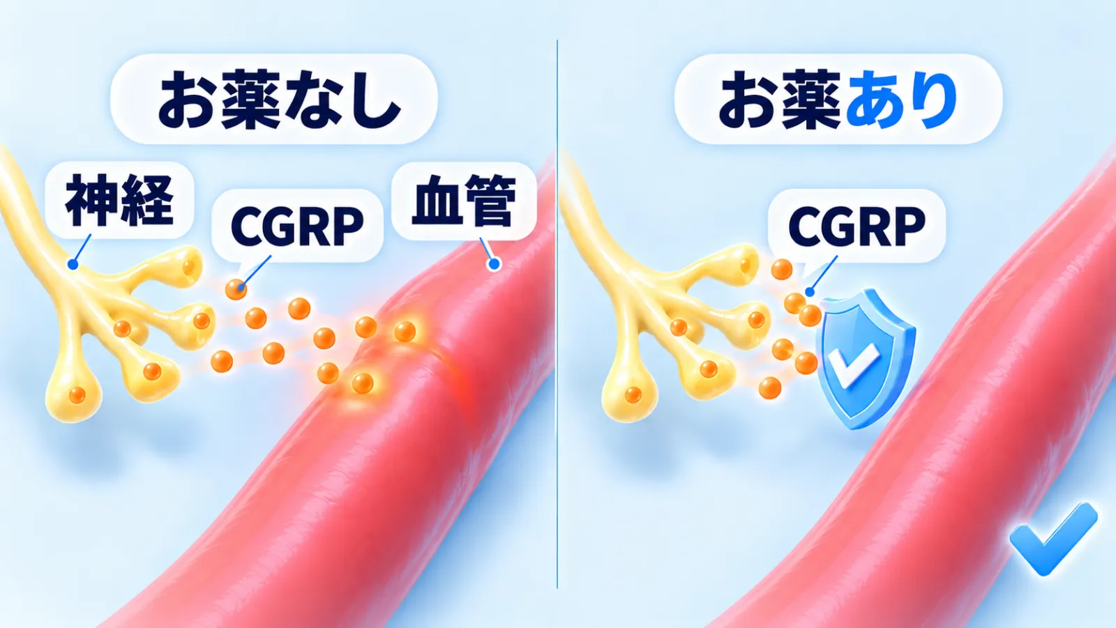 左右2場面の対比図。左「お薬なし」では、神経の末端から出たオレンジ色の粒（CGRP）が赤い血管に届き、血管が赤く光っている。右「お薬あり」では、神経と血管のあいだにある青い盾が粒をすべて受け止め、血管には届かない。この予防の注射は、この盾の役をしてCGRPのはたらきをブロックする。