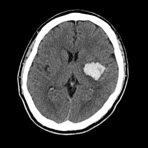 脳出血の頭部CT。脳の中に白く（明るく）写る血のかたまりを、点線の丸で示している。