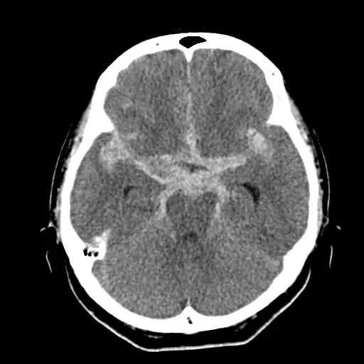 くも膜下出血の頭部CT。脳の表面の溝に沿って白く広がった出血を、点線の楕円で示している。