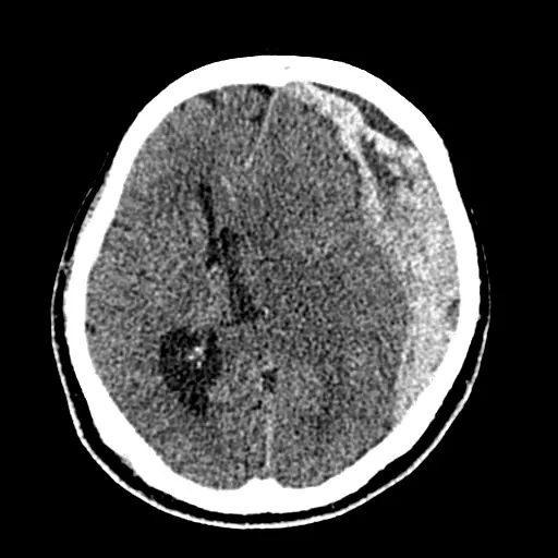 急性硬膜下血腫の頭部CT。片側の頭蓋骨のすぐ内側に白い三日月形の血液がたまり、脳が反対側へ押されて中心がずれている。点線の楕円で血腫を示している。