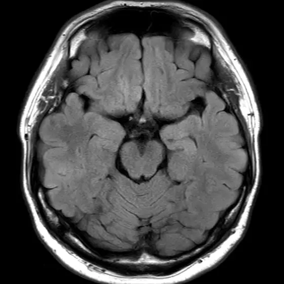 健常な方の頭部MRI（海馬の高さの断面）。左右の側頭葉の内側にある海馬がしっかりと詰まって写っている。