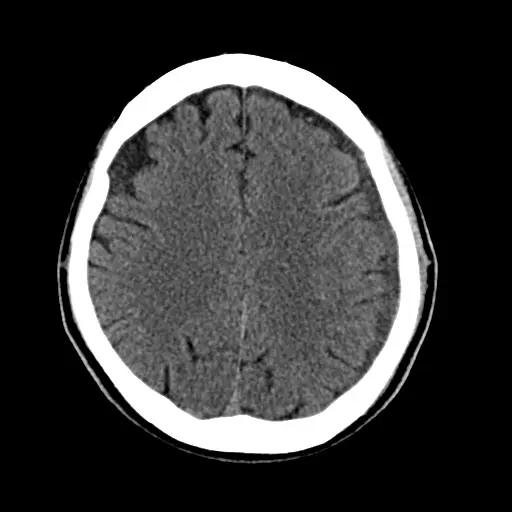 同じ方の手術後の頭部CT。たまっていた血液が抜け、脳のかたちが左右対称にもどっている。