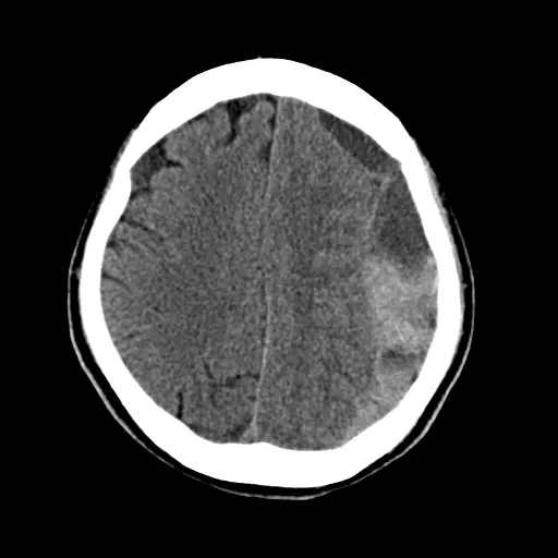 慢性硬膜下血腫の手術前の頭部CT。片側の頭蓋骨の内側に三日月形に血液がたまり、脳が反対側へ押されている。点線の楕円で血腫を示している。