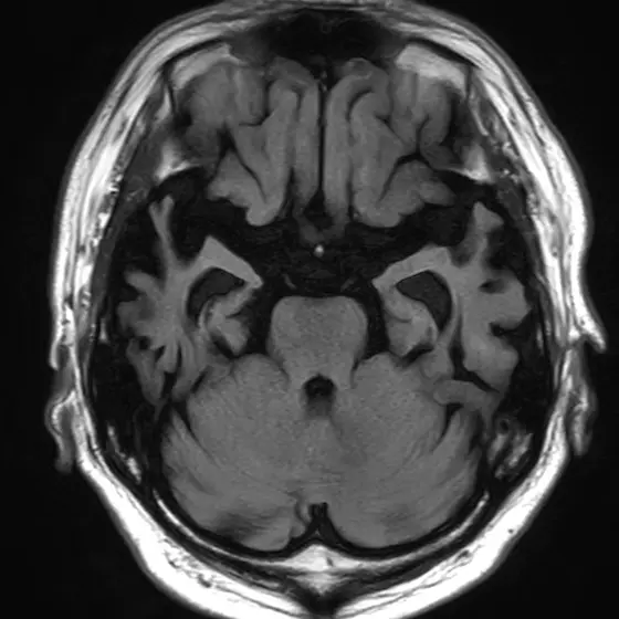 アルツハイマー型認知症の頭部MRI（海馬の高さの断面）。左右の海馬がやせて小さくなり、そのまわりの黒いすき間が広がっている。点線の楕円で海馬をふくむ側頭葉の内側を示している。