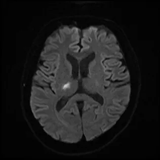 ラクナ梗塞のMRI（拡散強調画像）。脳の奥の細い血管の領域に、小さく白く光る点が写っている。点線の丸で示している。
