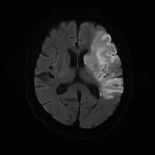 心原性脳塞栓症のMRI（拡散強調画像）。脳の片側の広い範囲が白く光っている。点線の楕円で範囲を示している。