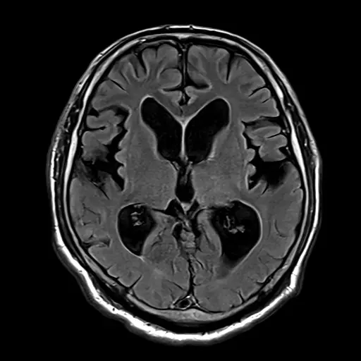 特発性正常圧水頭症の頭部MRI。中央の脳室が大きくふくらんでいる。点線の楕円で脳室を示している。