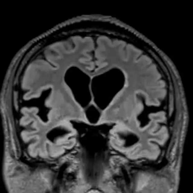 同じ特発性正常圧水頭症の方の頭部MRI（正面からの断面）。脳室が大きく、頭のてっぺん側では脳のしわのすき間が狭く詰まり、左右の側面ではすき間（シルビウス裂）が広がっている。点線の楕円でその3か所を示している。