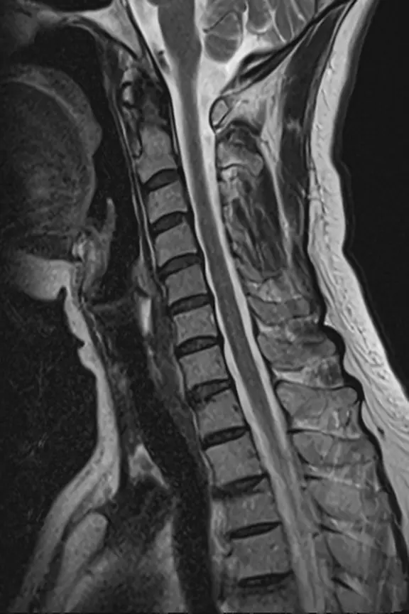 健常な方の頸椎MRI。首の骨の中を通る脊髄のまわりに、水（髄液）の白いすき間が上から下まで途切れずに続いている。