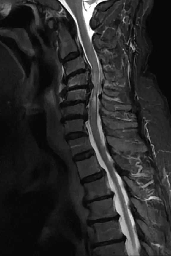 頸椎症性脊髄症の頸椎MRI。加齢で変形した骨と椎間板が後ろにせり出し、脊髄が前後から強く圧迫され、脊髄の中に白い変化が写っている。点線の楕円で圧迫されている場所を示している。