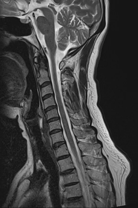 健常な方の頸椎MRI。脊髄の太さも明るさも上から下まで一様で、白く光る部分はない。