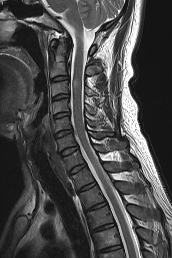 多発性硬化症の頸椎MRI。首の3番目の骨の高さで、脊髄の中に背骨1個分ほどの短い白い変化がみられる。点線の楕円で示している。