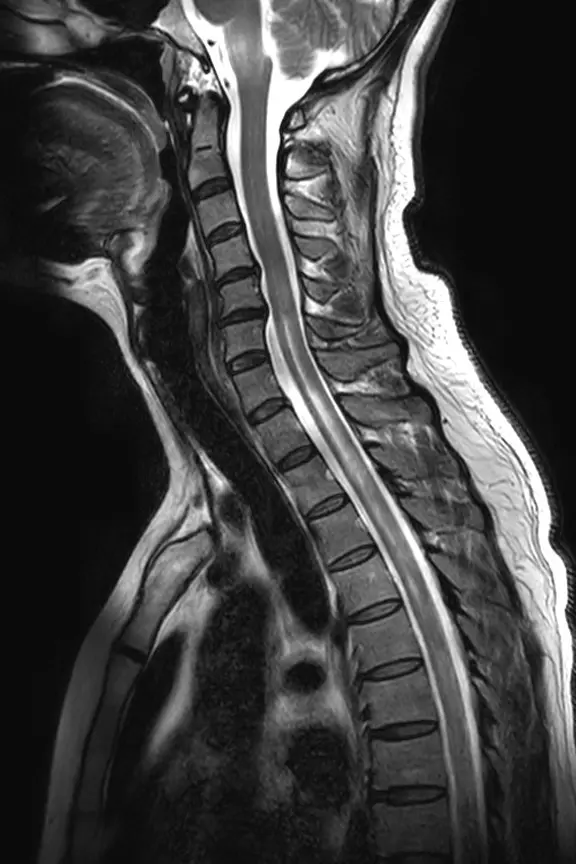 視神経脊髄炎スペクトラム障害の頸椎MRI。首の6番目から胸の5番目の骨まで、脊髄の中の白い変化が背骨3個分以上の長い範囲に及び、脊髄が腫れている。点線の楕円で示している。