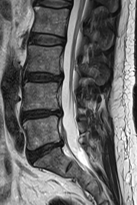 健常な方の腰椎MRI。腰の骨の中を通る神経の束のまわりに、水（髄液）の白い帯が上から下まで同じ太さで続いている。