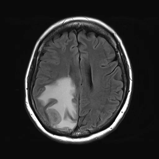 転移性脳腫瘍のMRI画像（頭を輪切りにした断面）。脳の後ろのほうに腫瘍があり、その周りに白っぽいむくみが広く広がっている。腫瘍を点線の丸で示している。