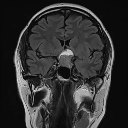 下垂体腺腫のMRI画像（顔の正面から見た断面）。目の神経のすぐ下にある下垂体から、上へ伸びる腫瘍を点線の丸で示している。