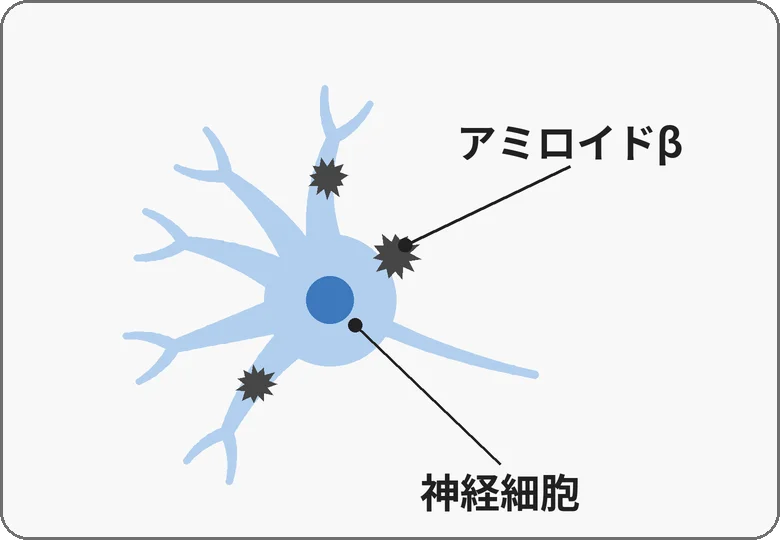 1つの神経細胞（青い、丸い体と枝）の体の縁と枝に、とげのある黒い小さなかたまり（アミロイドβ）が3つ付いている絵。