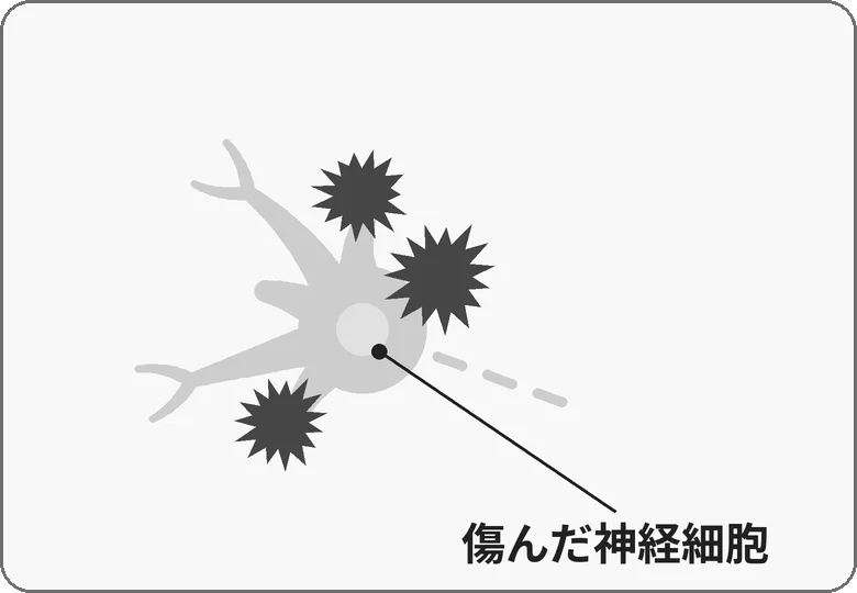 同じ神経細胞が灰色になり、枝が途中で途切れ、長い1本が点線になった絵（傷んだ神経細胞）。体の縁と枝に付いたかたまりは大きくなっている。