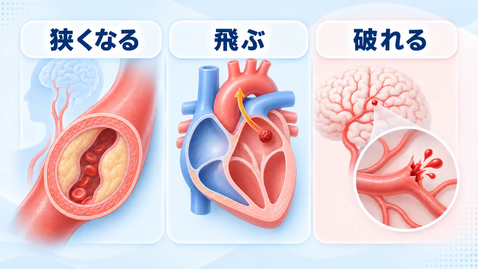 脳卒中が起きる前に血管で起きている3つの変化を並べた図。左は首から脳へ向かう太い血管の内側の壁が厚くなって通り道が狭くなる様子（狭くなる）、中央は心臓の左心房にできた血のかたまりが大動脈へ向かって飛び出す様子（飛ぶ）、右は脳の奥の細い血管が一点で破れる様子（破れる）。